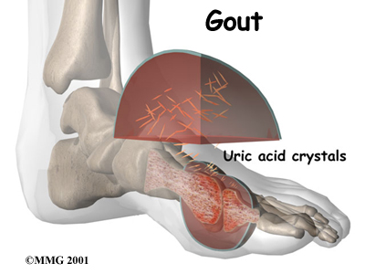 Nguyên nhân gây bệnh Gout - Vai trò acid uric